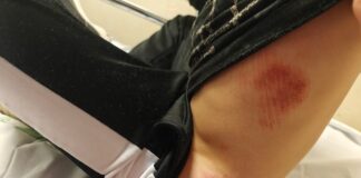 Localizado el conductor del patinete que ocasionaba daños a un menor menor atropellado